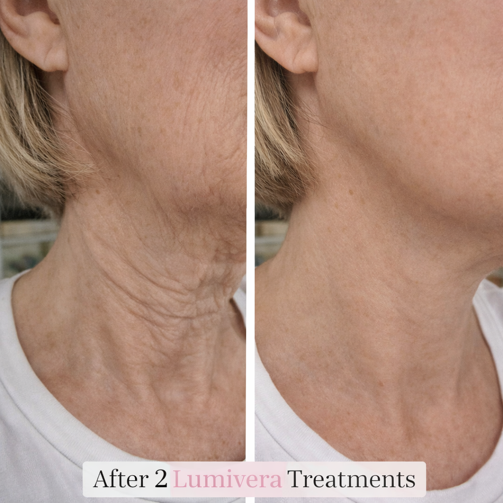 Lumivera Microneedling Infusion Kit