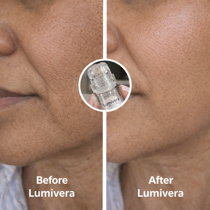 Lumivera Microneedling Infusion Kit